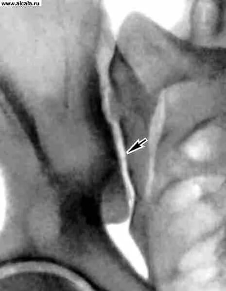 крестцово подвздошное сочленение болезнь сакроилеит. крестцово-подвздошное сочленение. крестцово-подвздошный сустав классификация. крестцово подвздошный сустав на человеке. • сакроилеит (воспаление крестцово-подвздошного сустава).