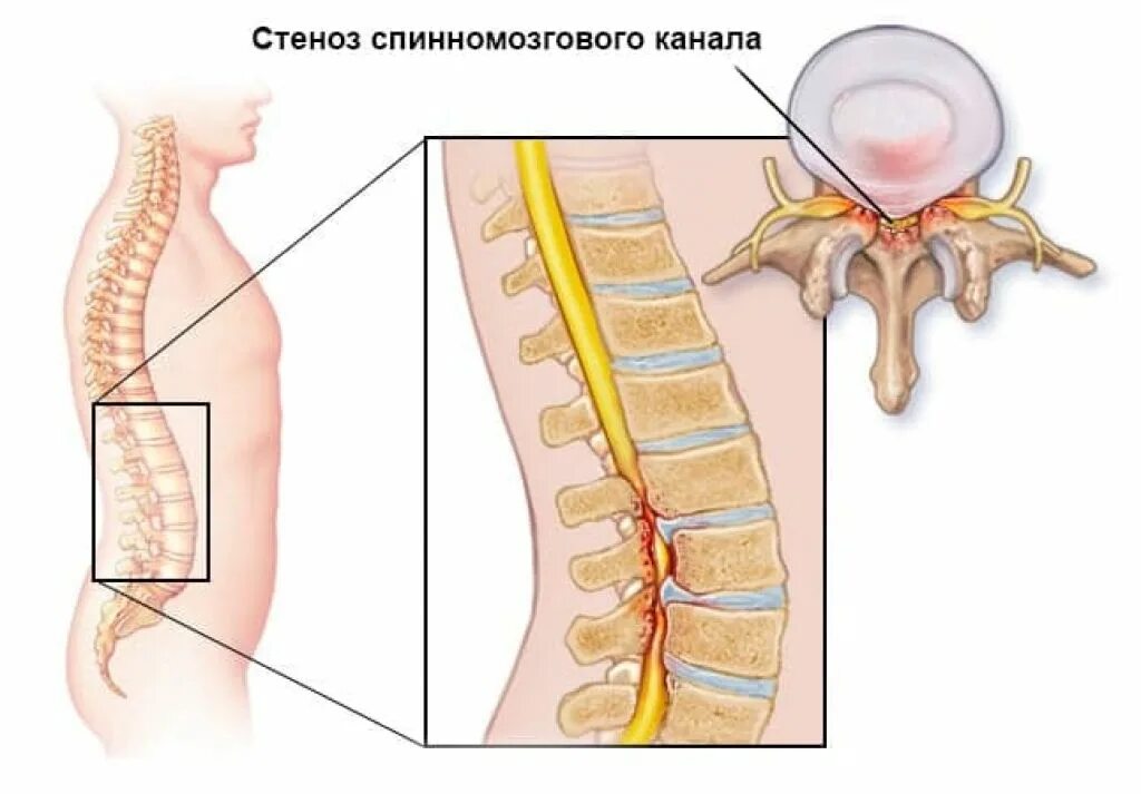 Стеноз позвоночного канала поясничного отдела. Стеноз спинномозгового канала в поясничном отделе. Спинальный стеноз поясничного отдела позвоночника. Стеноз позвоночного канала поясница.