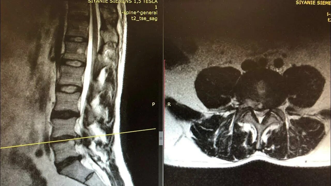 Грыжа l5-s1. Грыжа диска l5-s1. Рецидив межпозвоночной грыжи.