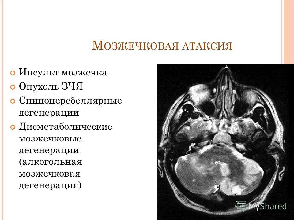 Дегенерация головного. Алкогольная дегенерация мозжечка. Мозжечковая дегенерация мрт. Дегенерация мозжечка мрт.