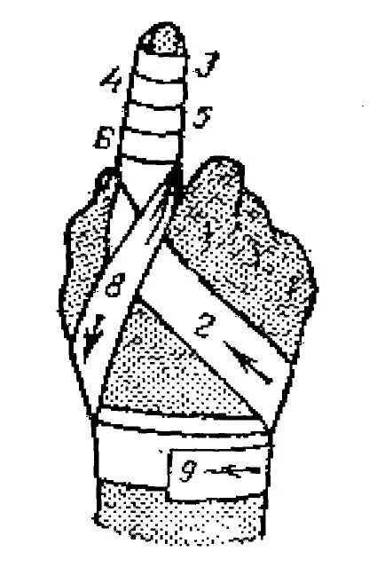 Техника наложения повязки перчатка. Наложение повязки Рыцарская перчатка. Рыцарская перчатка повязка алгоритм наложения. Рыцарская перчатка повязка показания. Наложить повязку Рыцарская перчатка.