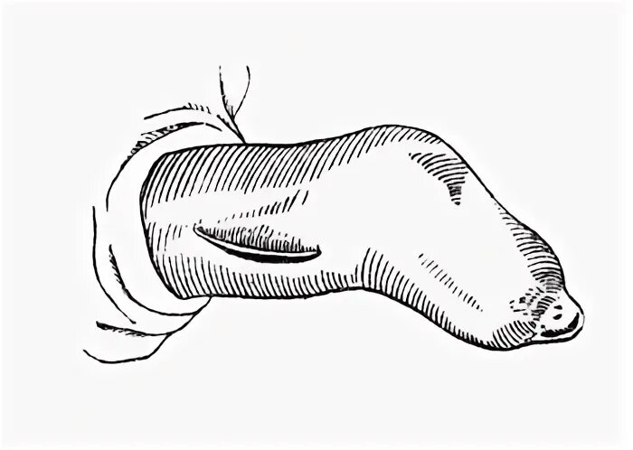 Уровни ампутации нижней конечности. Патологическая культя. Порочная ампутационная культя. Порочная культя. Показания к ампутации ноги.