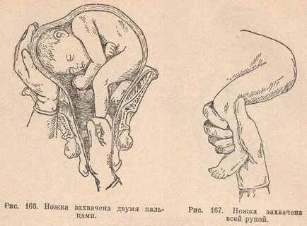 37 неделя беременности тазовое