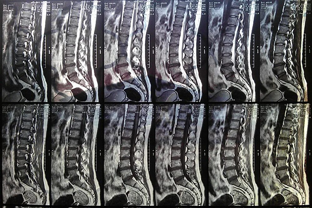 Мрт пояснично крестцового отдела позвоночника цена москва. Мрт пояснично-крестцового отдела позвоночника. Снимок мрт поясничного отдела позвоночника. Снимок мрт пояснично крестцового отдела позвоночника. Мрт крестцового отдела позвоночника.