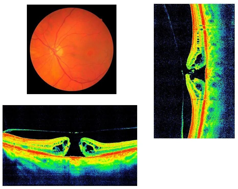 Макулодистрофия, макулярная дегенерация. Макулярная дистрофия сетчатки. Отслойка сетчатки глазное дно. Повреждение сетчатки