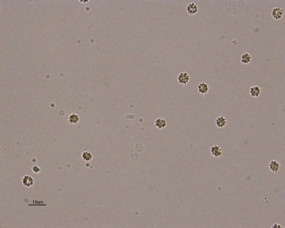Выщелоченные эритроциты в моче под микроскопом. Измененные эритроциты в моче микроскопия. Эритроциты выщелоченные микроскопия. Лейкоциты в моче микроскопия. Эритроциты и лейкоциты в моче у мужчин