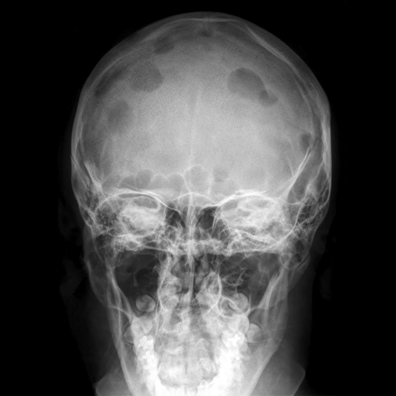 Кости черепа рентген. Туберкулез лобной кости. Остеома лобной рентген. Перелом теменной кости черепа рентген. Туберкулёз костей черепа на рентгене.