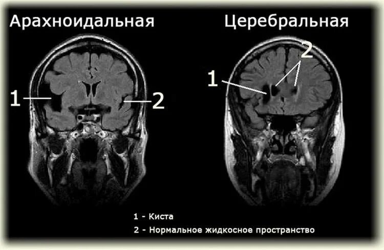 Ретроцеребеллярная ликворная киста кт. Ретроцеребеллярная арахноидальная киста мрт. Арахноидальная ликворная киста кт. Арахноидальная ликворная киста мрт. Арахноидальные изменения ликворокистозного характера