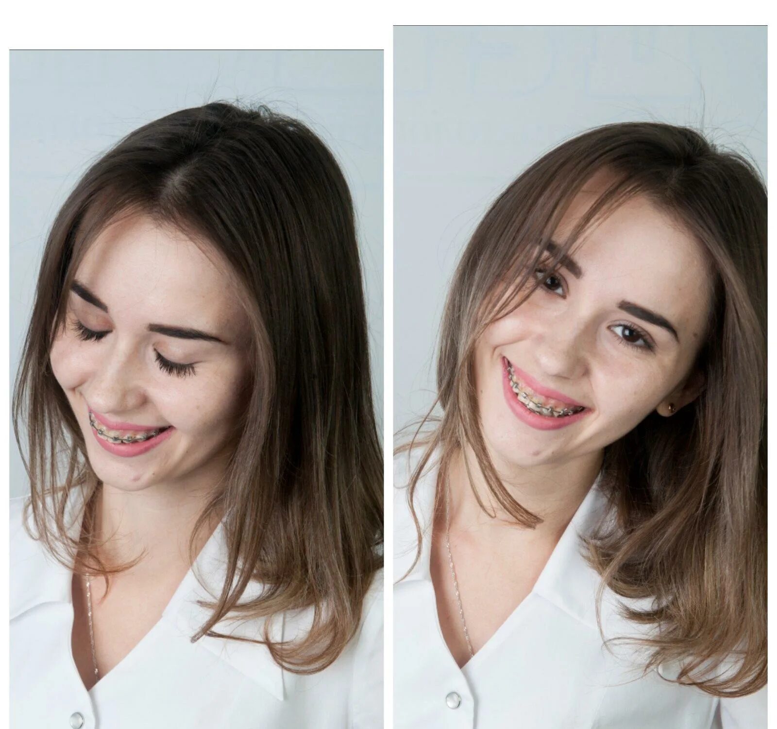 Овал лица до и после брекетов. Лицо до и после брекетов без улыбки. Изменения после брекетов