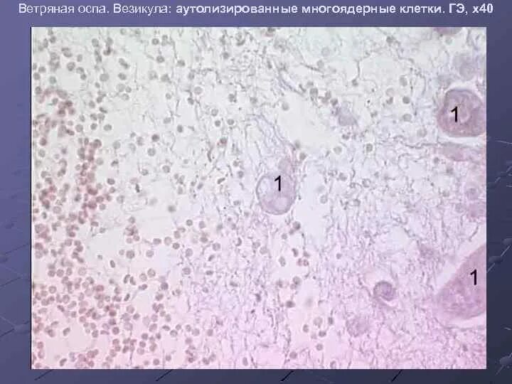 Везикула при ветрянке микропрепарат. Везикула при ветряной оспе патанатомия. Патологическая анатомия ветряной оспы. Ветряная оспа микропрепарат.