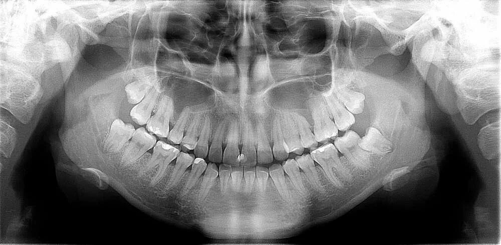 Снимок зубов видное. Ортопантомограмма челюсти. Ортопантомография (ОПТГ).