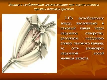 Прямые паховые грыжи операции