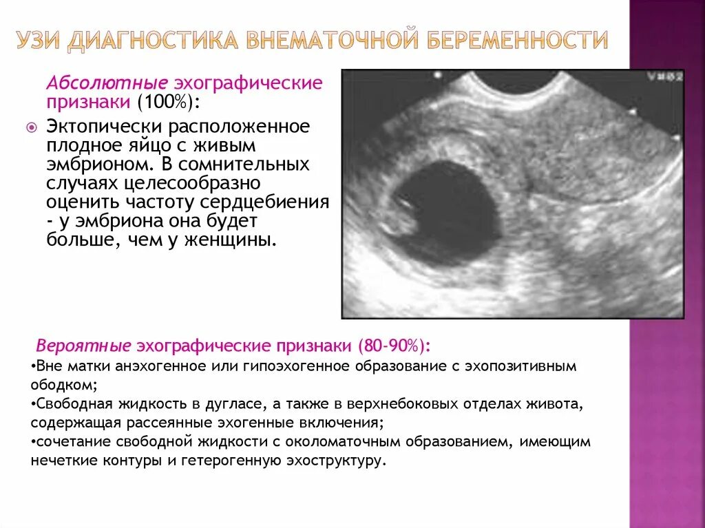 Внематочная беременность 6 недель УЗИ. Внематочная беременность эхограммы. УЗИ при внематочной беременности на ранних сроках. Замершая внематочная беременность на УЗИ.