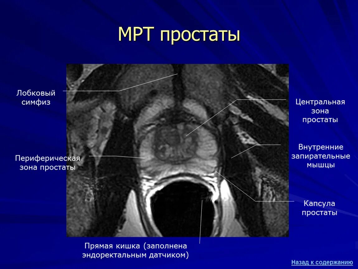 Делают мрт предстательной железы. Аденома предстательной железы мрт. анатомия предстательной железы мрт. гиперплазия предстательной железы мрт. эндоректальная катушка мрт.