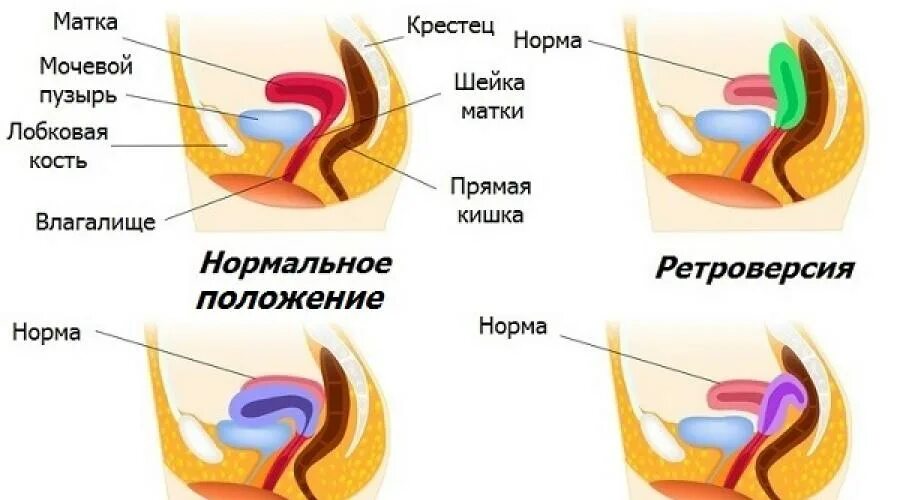 Изгиб шейки. Шейка матки кзади. Матка отклонена кзади. Отклонение шейки матки кзади.