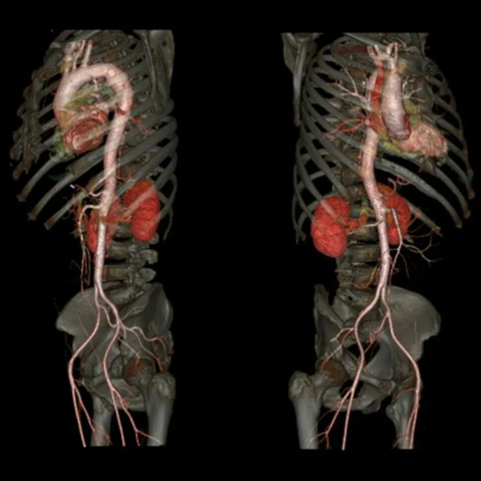 Мультиспиральная компьютерная томография (МСКТ). Мультиспиральная многослойная компьютерная томография. Магнитно-резонансная ангиография аорты. Мультисрезовая компьютерная томография (МСКТ). Кт органов брюшной полости грудной клетки