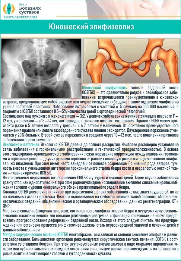 Коксартроз тазобедренного 1 степени у женщин лечение. Эпифизеолиз тазобедренного сустава. Эпифизит тазобедренного сустава. Юношеский эпифизеолиз головки бедренной кости. Юношеский эпифизеолиз головки бедренной кости рентген.