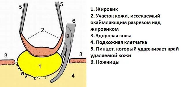 Атерома что это такое фото и описание Жировики на лице: почему появляются, виды, как избавиться