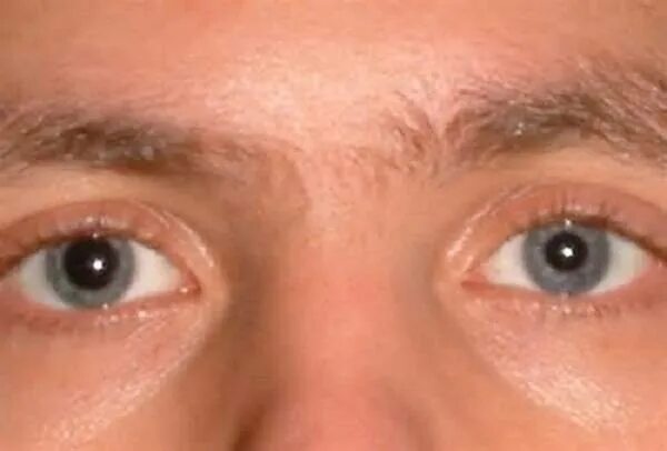 Анизокория карие глаза. Разные зрачки.