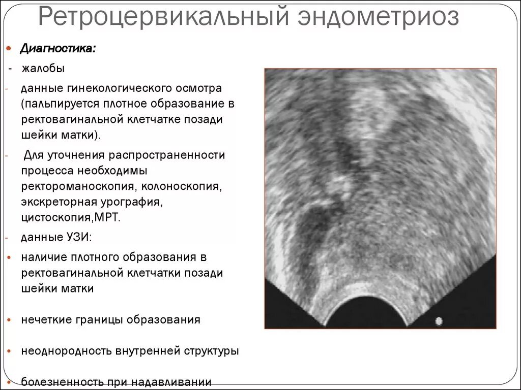 Признаки эндометриоза на узи что это. Ретроцервикальный эндометриоз на УЗИ. Ретроцервикальный эндометриоз дифференциальная диагностика. Эндометриома шейки матки УЗИ. Ретроцервикальный аденомиоз мрт.