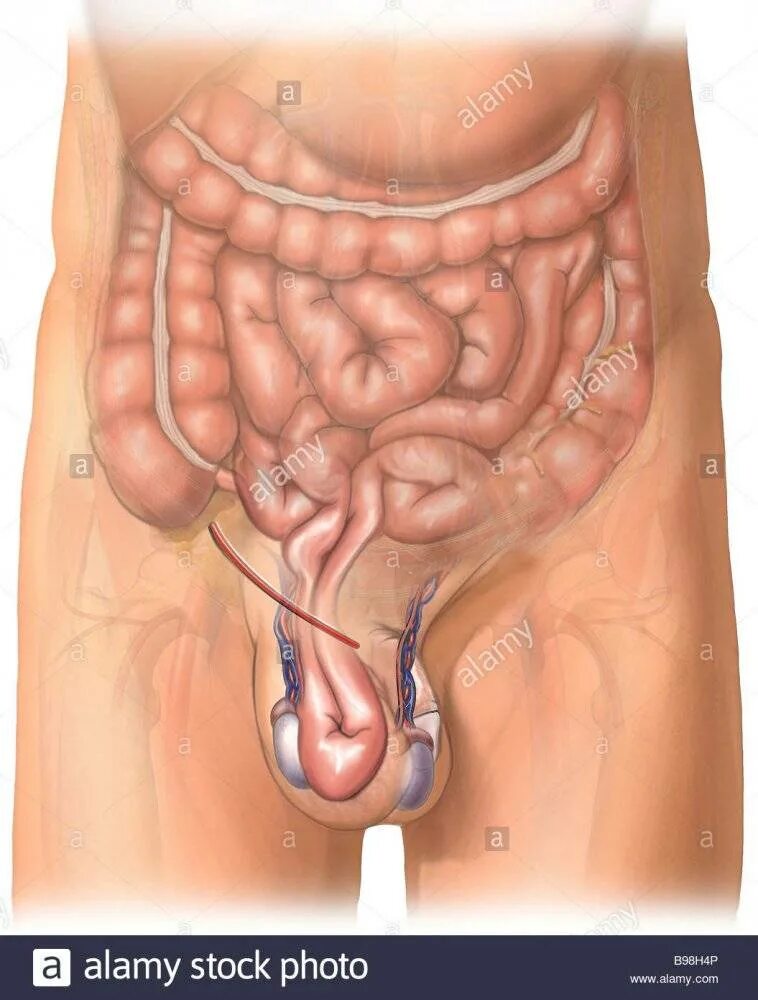 Вправимая паховая грыжа. Паховомашоночная грыжа. Паховой мошоночной грыжи. Яички в брюшную полость