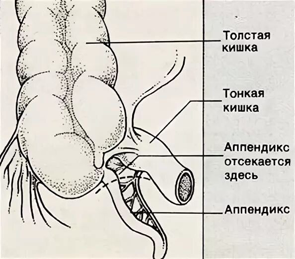 ОСТРЫЙ АППЕНДИЦИТ.Балтийский федеральный университет имени И. Канта КАФЕДРА