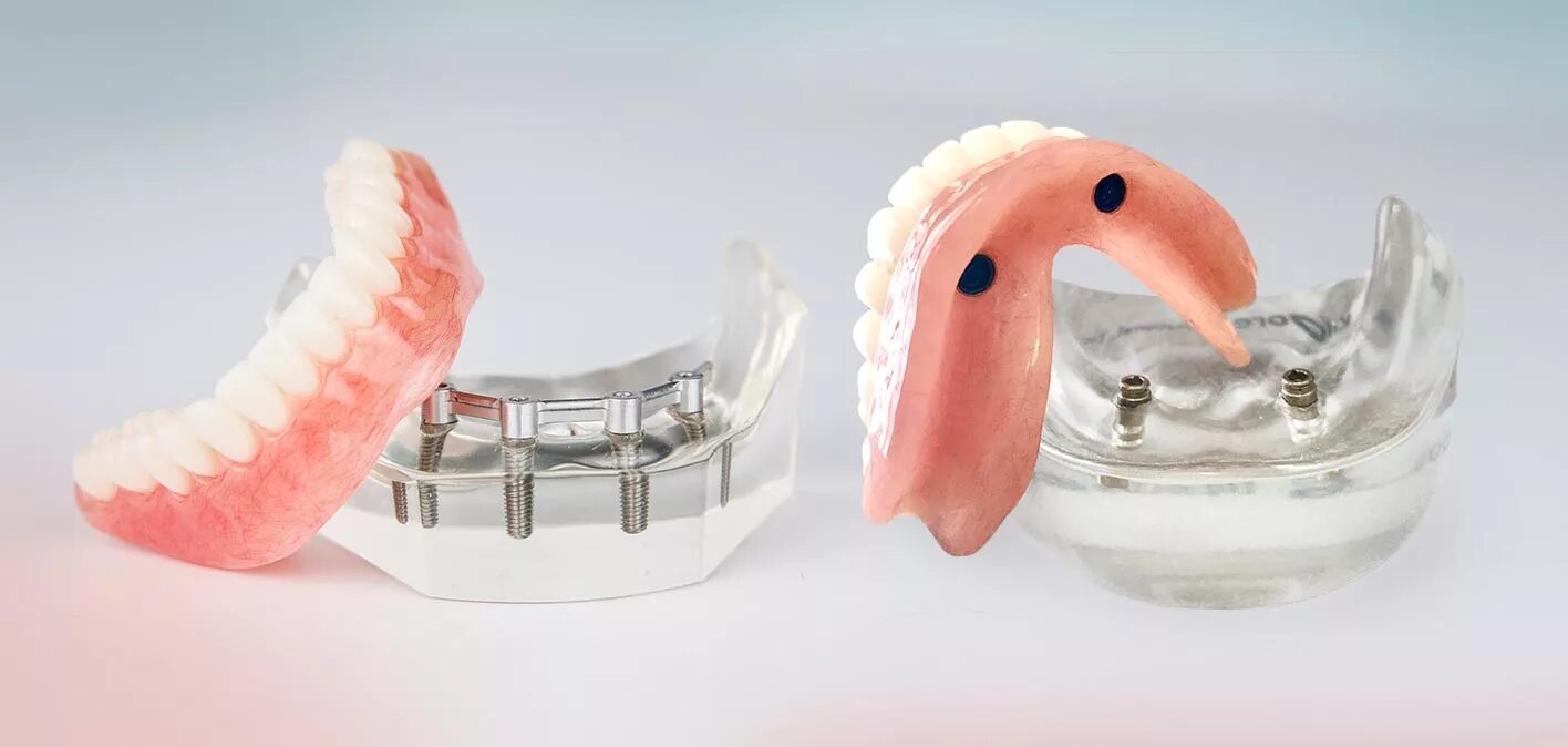 Зубные протезы нового поколения цена. Покрывные протезы ортопедическая стоматология. Перекрывающие съемные протезы.