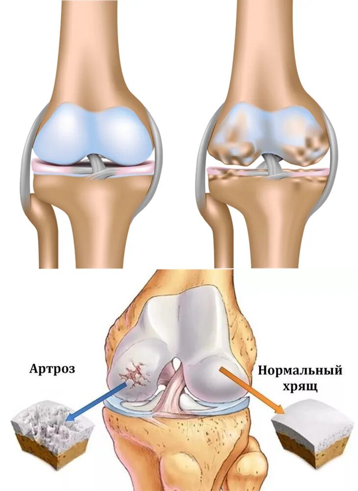 Артрит суставов стадии