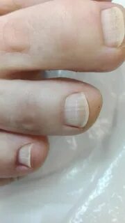 На пальцах ног белые полоски
