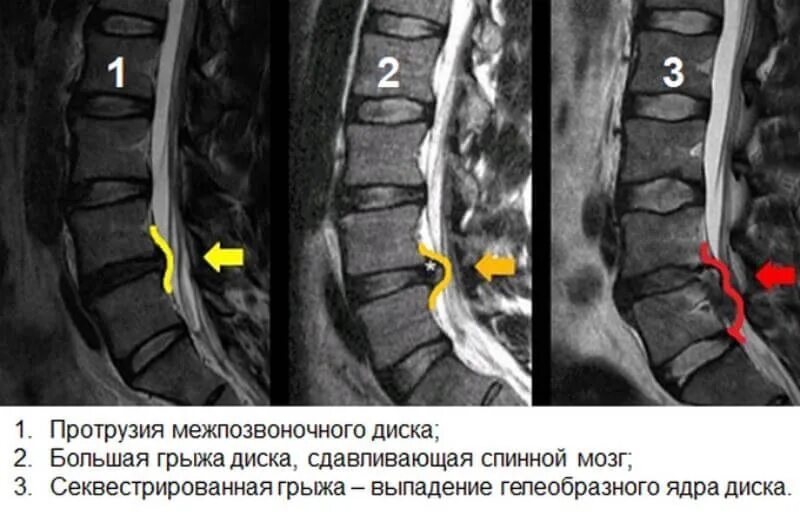Лечение протрузии диска l5. Экструзия диска l5-s1 что это такое. протрузии дисков l3-l5. протрузии дисков позвоночника мрт. грыжа и протрузия поясничного отдела.