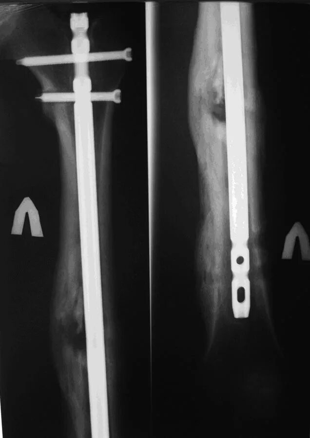 Остеосинтез pfn перелом бедра. Ложный сустав после перелома бедренной кости. Ложный сустав диафиза бедра. Функция бедренной кости человека. Сросшийся перелом бедренной кости рентген.