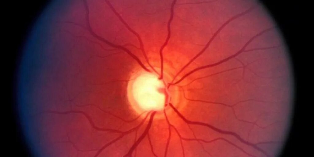 Кровообращение зрения. Ишемическая оптикопатия зрительного нерва. Ишемическая нейропатия зрительного нерва. Патологии зрительного нерва глаукома. Нейропатия зрительного нерва Лебера.