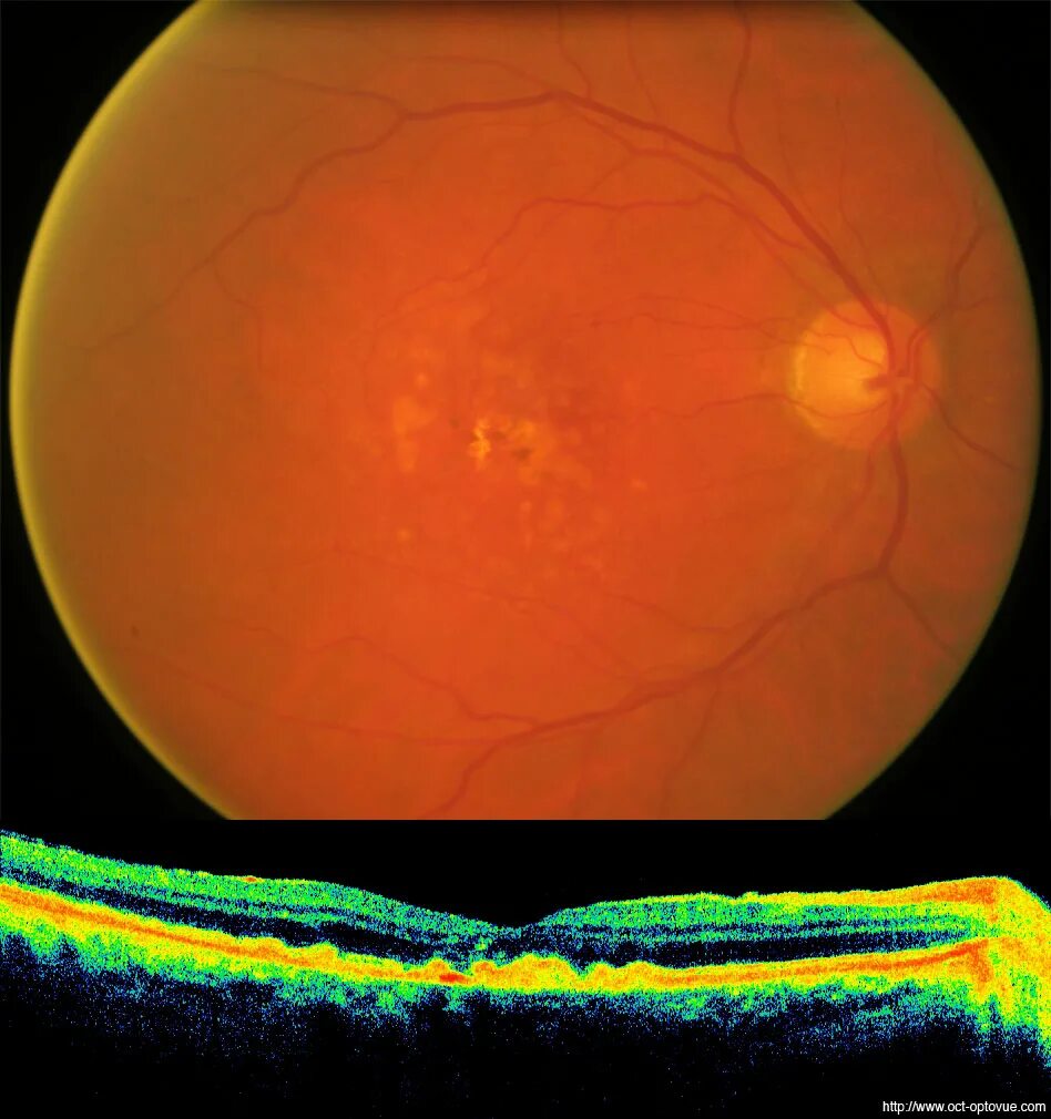 Лечение дегенерации макулы. Дегенерация макулы клетка.