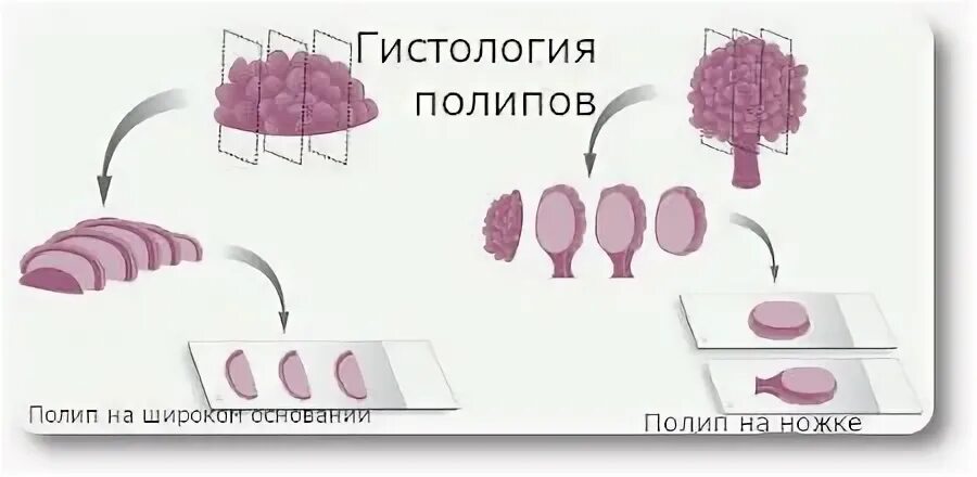 Микровезикулярный полип толстой кишки. Полип толстой кишки гистология. Аденоматозный полип гистология. Полип кишечника гистология. Причины образования полипов.