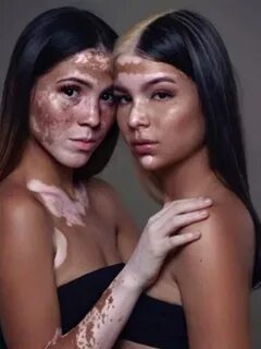 Пигмент кожи загар