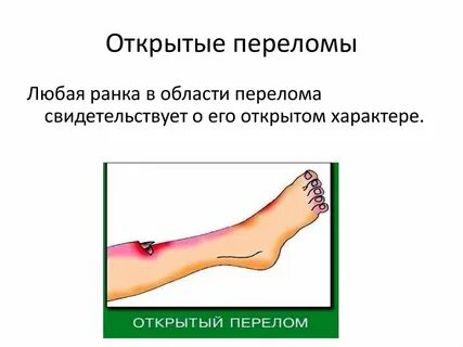 Перелом при котором линия перелома начинается