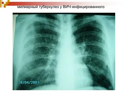 Туберкулез легких при вич