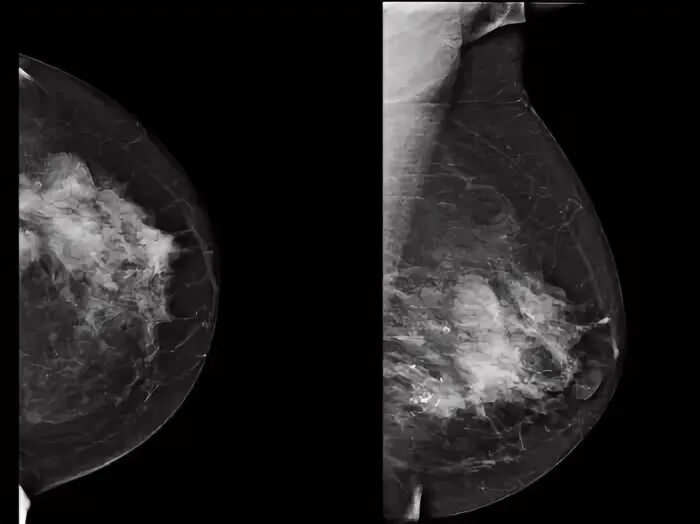 Фиброзно-кистозная мастопатия маммография. Фиброзно кистозная мастопатия маммограмма. Фиброзно-кистозная мастопатия молочных на маммографии. Фиброзно-кистозная мастопатия рентген. Диффузно фиброзно кистозная изменения