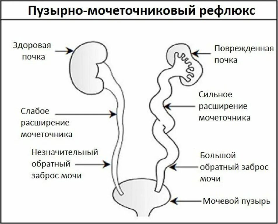 Дилатация мочеточника. Пузырно-мочеточниковый рефлюкс (ПМР). Пузырномочеточниковый ркфлюкс. Пузырно-мочеточниковый рефлюкс патогенез. Врожденный пузырно-мочеточниково-почечный рефлюкс.