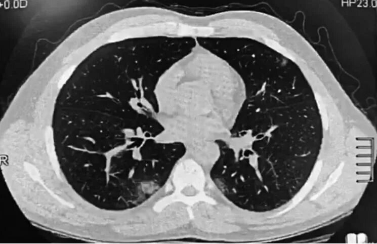Кт легких пневмония коронавирус. Пневмония при коронавирусе на кт. Кт легких при коронавирусе. Поражением легких 50