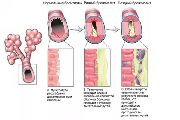 Бронхиолит причины. Хронический облитерирующий бронхиолит этиология. этиология хронического облитерирующего бронхиолита:. клинические симптомы облитерирующего бронхиолита. облитерирующий бронхиолит («попкорновая болезнь»).