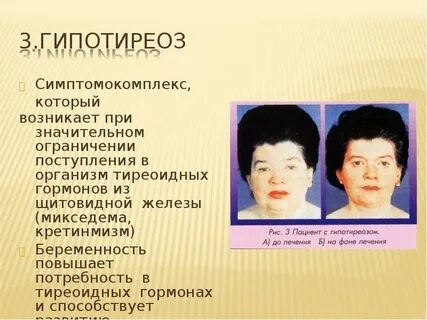 Гипотериоз после лечения