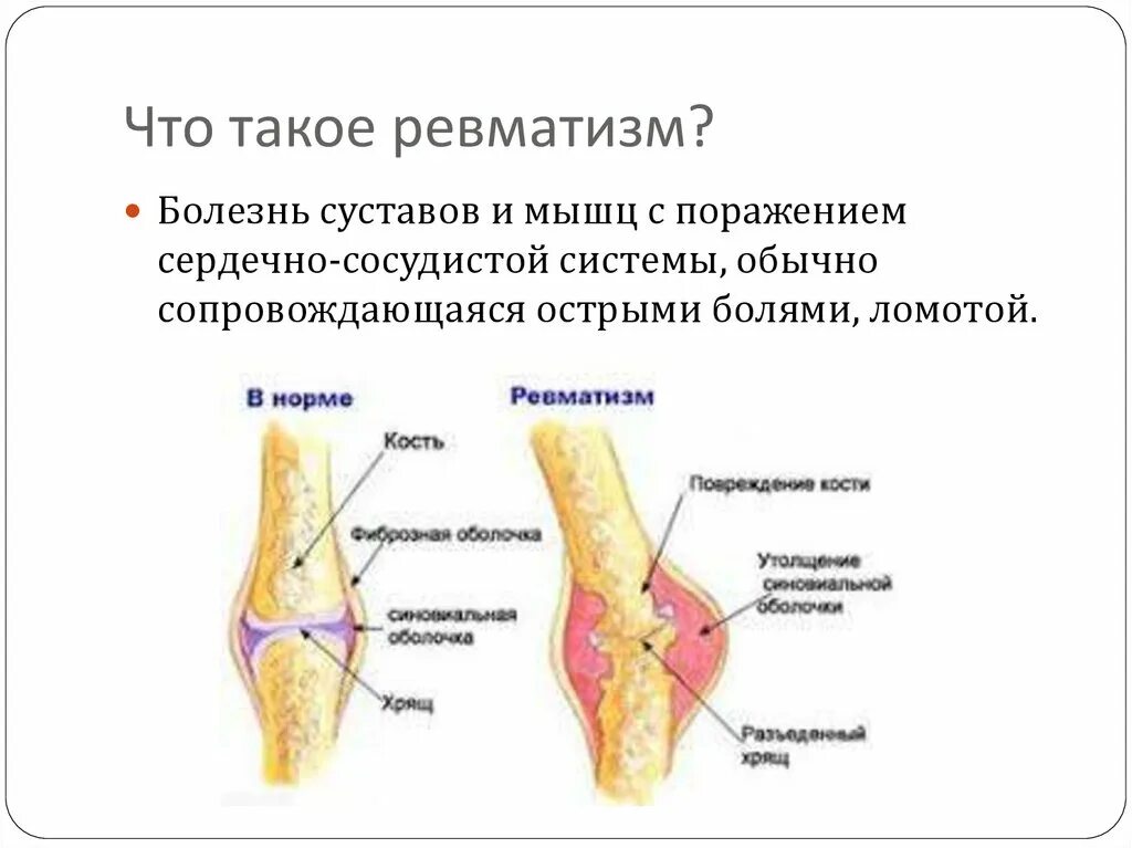 Симптомы суставного ревматизма. Ревматизм поражение суставов. Симптомы ревматизма у взрослых суставы.