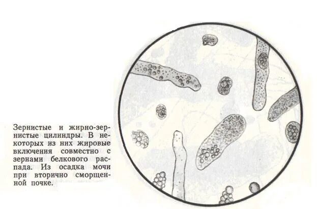 Моча цилиндры гиалиновые повышенные. Гиалиновые цилиндры микроскопия. Зернистые и восковидные цилиндры в моче. Зернистые цилиндры. Зернистые цилиндры в моче.