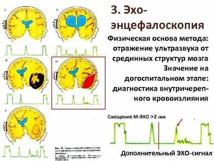 Эхо мм