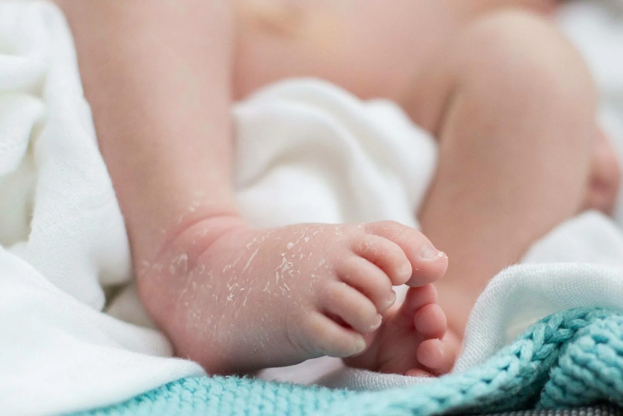 Лечение трещин у ребенка. Сухая кожа у новорожденных. Шелушение кожи у новорожденного. Сухость кожи у новорожденного.
