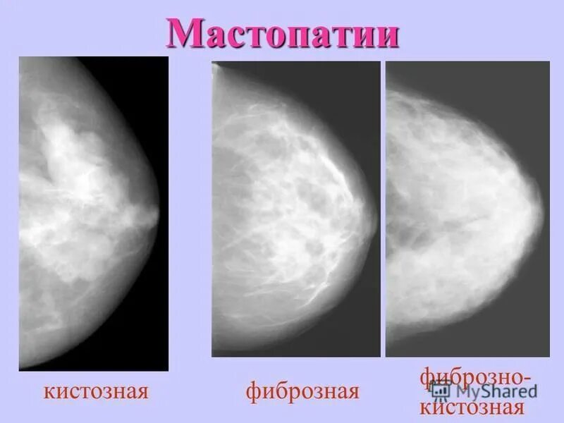 Кистозная мастопатия маммография. Фиброзно-кистозная мастопатия маммография. Фиброзная мастопатия на маммографии. Узловая форма ФКМ молочной железы маммография. Двухсторонняя диффузная