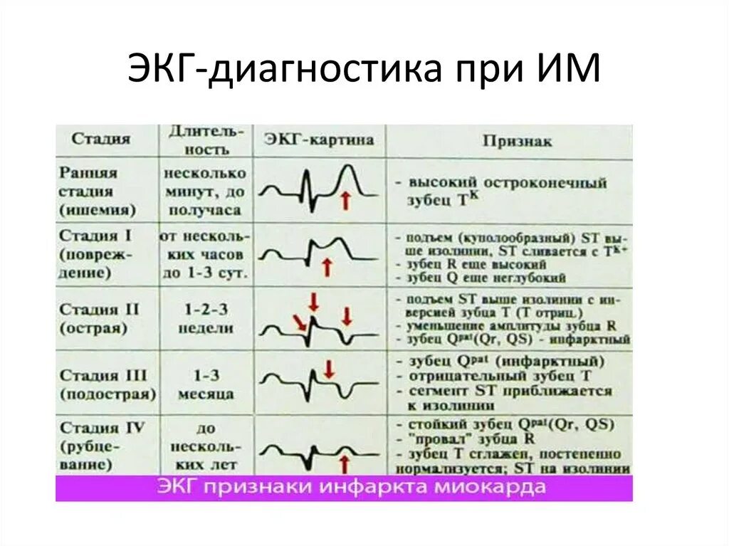 ЭКГ признаки стадий инфаркта миокарда. ЭКГ диагностика инфаркта миокарда по стадиям. ЭКГ признаки инфаркта миокарда на ЭКГ. Стадии инфаркта миокарда на ЭКГ.