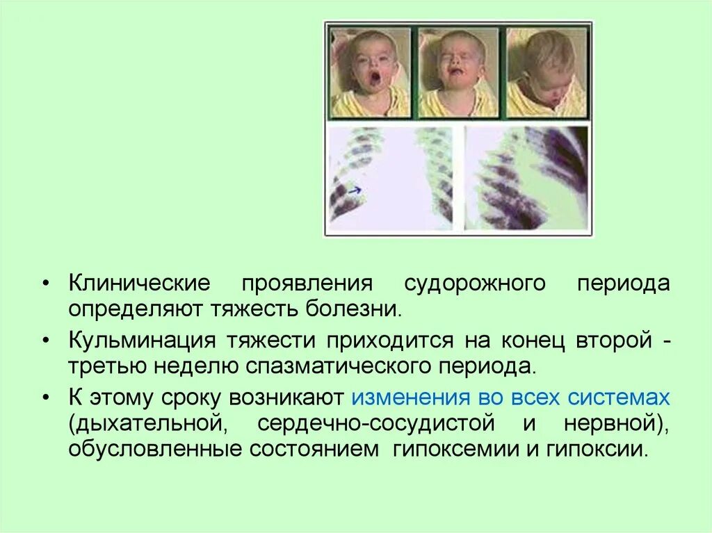 Наблюдение коклюша