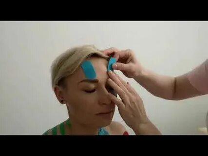 Нависшее веко тейпирование
